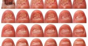 Toenail Fungus Cure: Toenail Fungus Cures - Which are best?