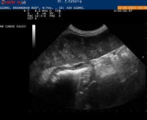 Pulmonary edema noncardiogenic