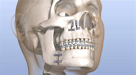 Jaw Surgery (Orthognathic Surgery) Boulder - Foley & Le Oral Surgery | Jaw Surgeon Boulder