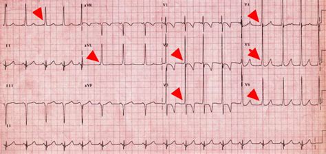 Wolff Parkinson White Syndrome - Causes, Symptoms, Treatment