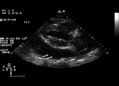 Pericardial Effusion: Practice Essentials, Background, Pathophysiology