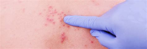 Herpes Zoster Infections