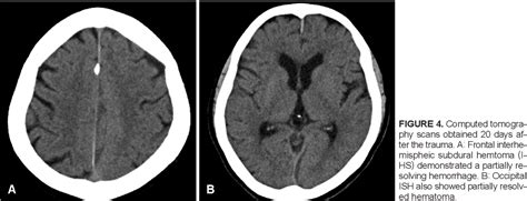 [PDF] Interhemispheric Subdural Hematoma Presenting with Falx Syndrome after Trauma | Semantic ...