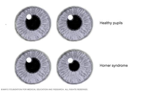 Horner syndrome - Symptoms and causes - Mayo Clinic