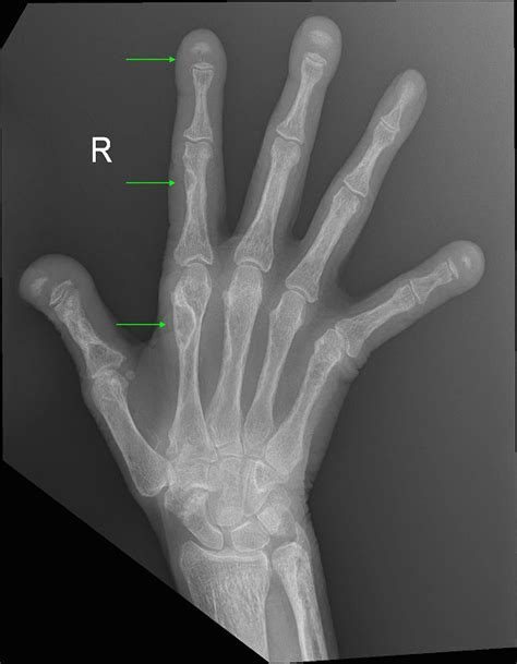 Osteitis Fibrosa Cystica X Ray