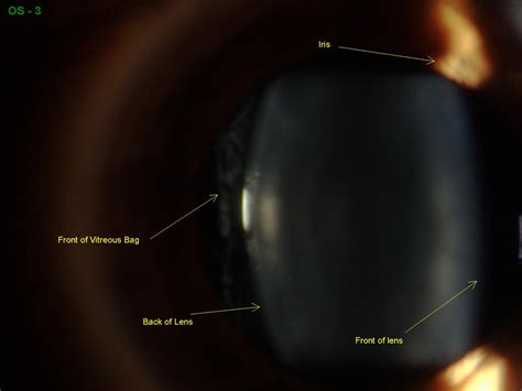 Anterior Vitreous Detachment | Sonoran Desert Eye Center