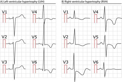 ECG in left ventricular hypertrophy (LVH): criteria and implications ...