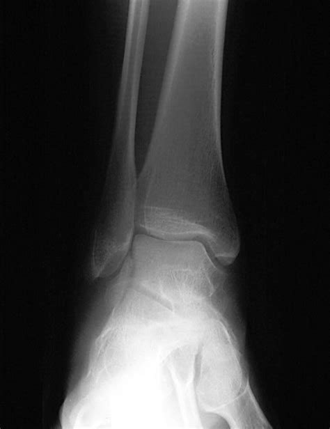 Fracture of lateral process of the talus presenting as ankle pain | Emergency Medicine Journal