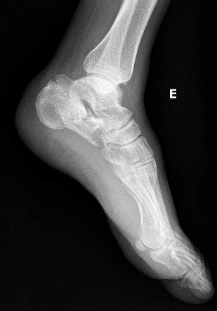 Calcaneal fracture - tongue-type | Image | Radiopaedia.org