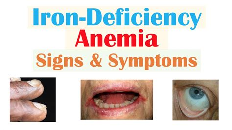 Can Anemia Cause Pale Lips | Lipstutorial.org