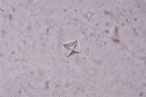 Calcium Oxalate Crystals In Synovial Fluid