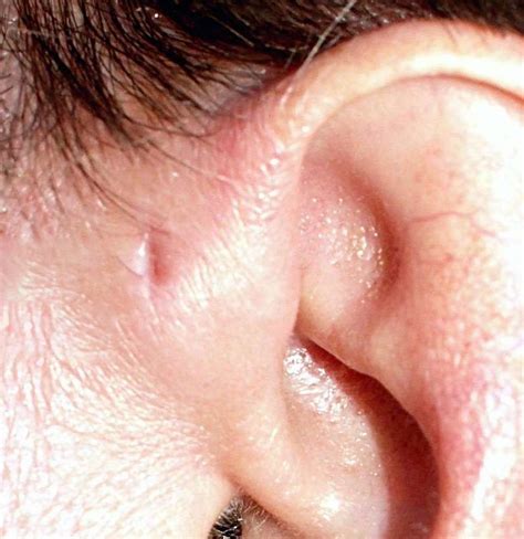 Ear Infection Ear Hole at David Roberts blog