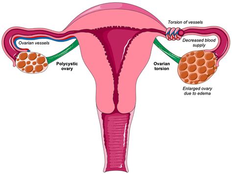 Biomedicines | Free Full-Text | Ovarian Torsion in Polycystic Ovary Syndrome: A Potential Threat?