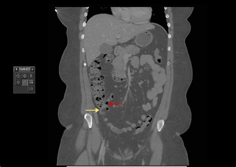 Epiploic Appendagitis Masquerading as Acute Appendicitis: A Report of Two Cases | Cureus