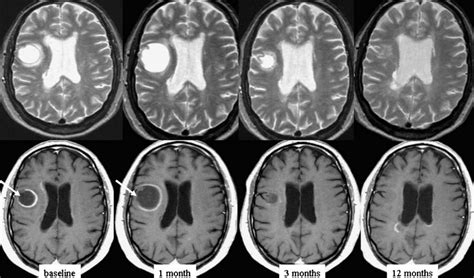 Tumefactive form of RR MS. Serial brain T2-W MR images (upper row) and... | Download Scientific ...