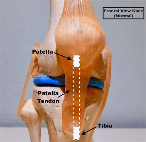 Essentials of Choosing an ACL Graft