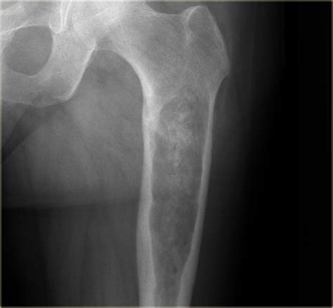 CHONDROSARCOMA | Buyxraysonline