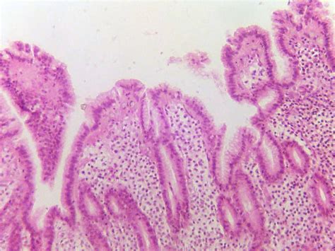 Tumor Thickness Indicates 10-Year Survival for Mucosal Melanoma