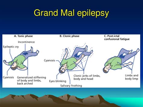 PPT - EPILEPSY PowerPoint Presentation, free download - ID:1947946