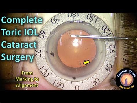 Torque lenses for cataract surgery | doctorvisit