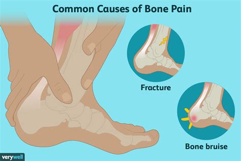 Bone Pain: Causes, Treatment, and When to See a Healthcare Provider