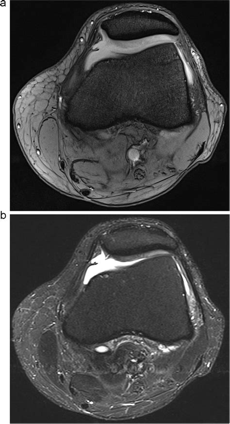 Cartilaginous fissure of the medial aspect of the patella imaged with ...