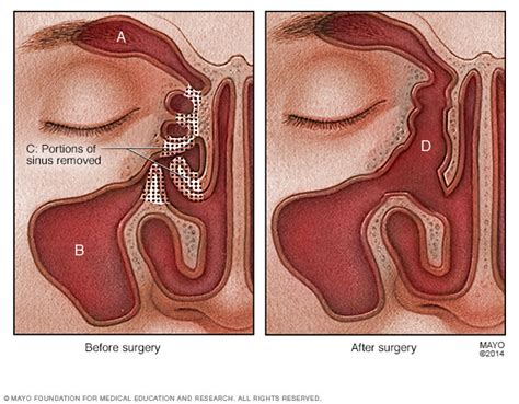 Nasal polyps Disease Reference Guide - Drugs.com