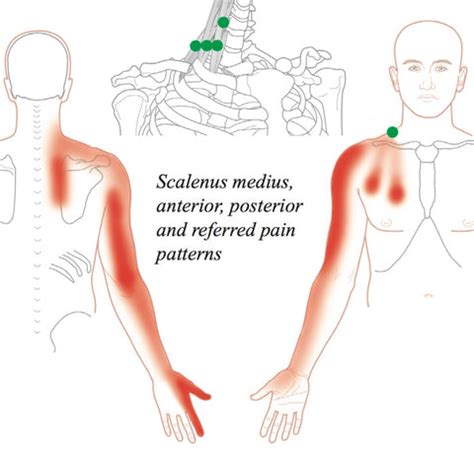 Trigger Point Therapy - Treating the Scalenes – Niel Asher Education