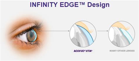 Acuvue Vita for Astigmatism – New Monthly Contact Lens for Astigmatism - Contacts Advice