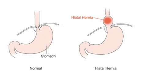 Hiatal Hernia - Bonheur, MD - Gastroenterologist