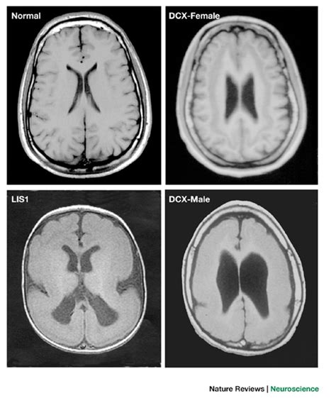 Lissencephaly Mri