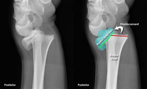 Trauma X-ray - Upper limb gallery 1 - Wrist - Salter-Harris fracture