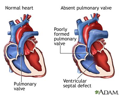 Absent pulmonary valve: MedlinePlus Medical Encyclopedia Image