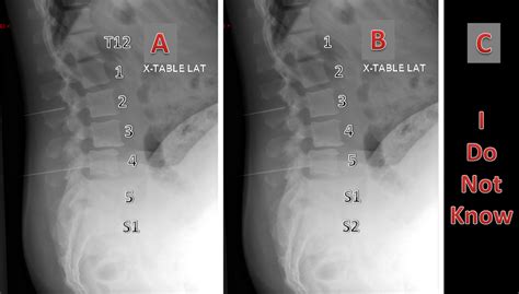 Transitional Lumbosacral Vertebra