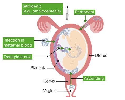 Chorioamnionitis: Causes, Symptoms, Diagnosis Treatment, 48% OFF