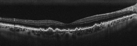 Bay Eye Care — Glaucoma and Retinal Disease