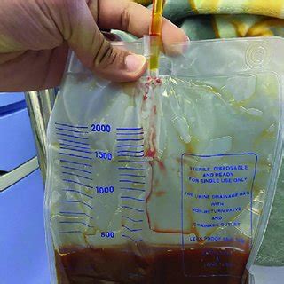 Photograph of the purulent biliary fluid obtained after the drainage. | Download Scientific Diagram