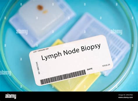 Lymph node biopsy. A lymph node or a small piece of lymph node tissue ...