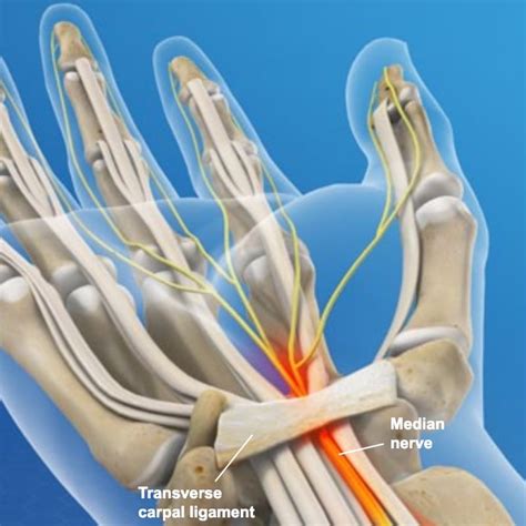 Carpal Tunnel Release | Sierra Neurosurgery Group