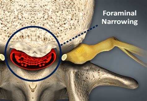 Foraminal Stenosis | Causes, Symptoms & Treatment | Bonati