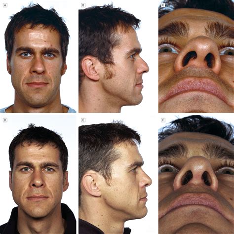 Reconstruction of the Nasal Septum Using Perforated and Unperforated Polydioxanone Foil | Facial ...