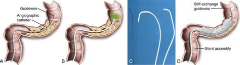 Preoperative and Palliative Colonic Stenting | Radiology Key