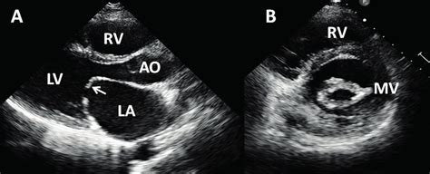 Transthoracic echocardiography from patient with severe mitral stenosis... | Download Scientific ...