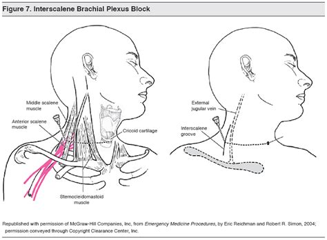 Intercostal Nerve Block