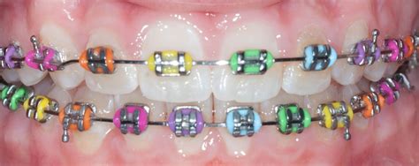 Braces • Bethlehem, PA • Serving Hellertown, Saucon, Whitehall