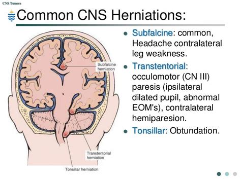 transtentorial herniation - Google Search | Emergency medicine, Anatomy and physiology, Cns