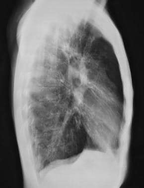 Cystic Fibrosis Chest X Ray