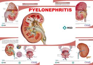 Pyelonephritis – Anejo