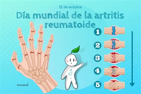 Día mundial de la Artritis reumatoide - Somosdisc@