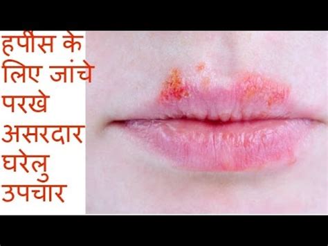 हर्पीस के लिए जांचे परखे असरदार घरेलु उपचार Home remedies for Harpies # ...